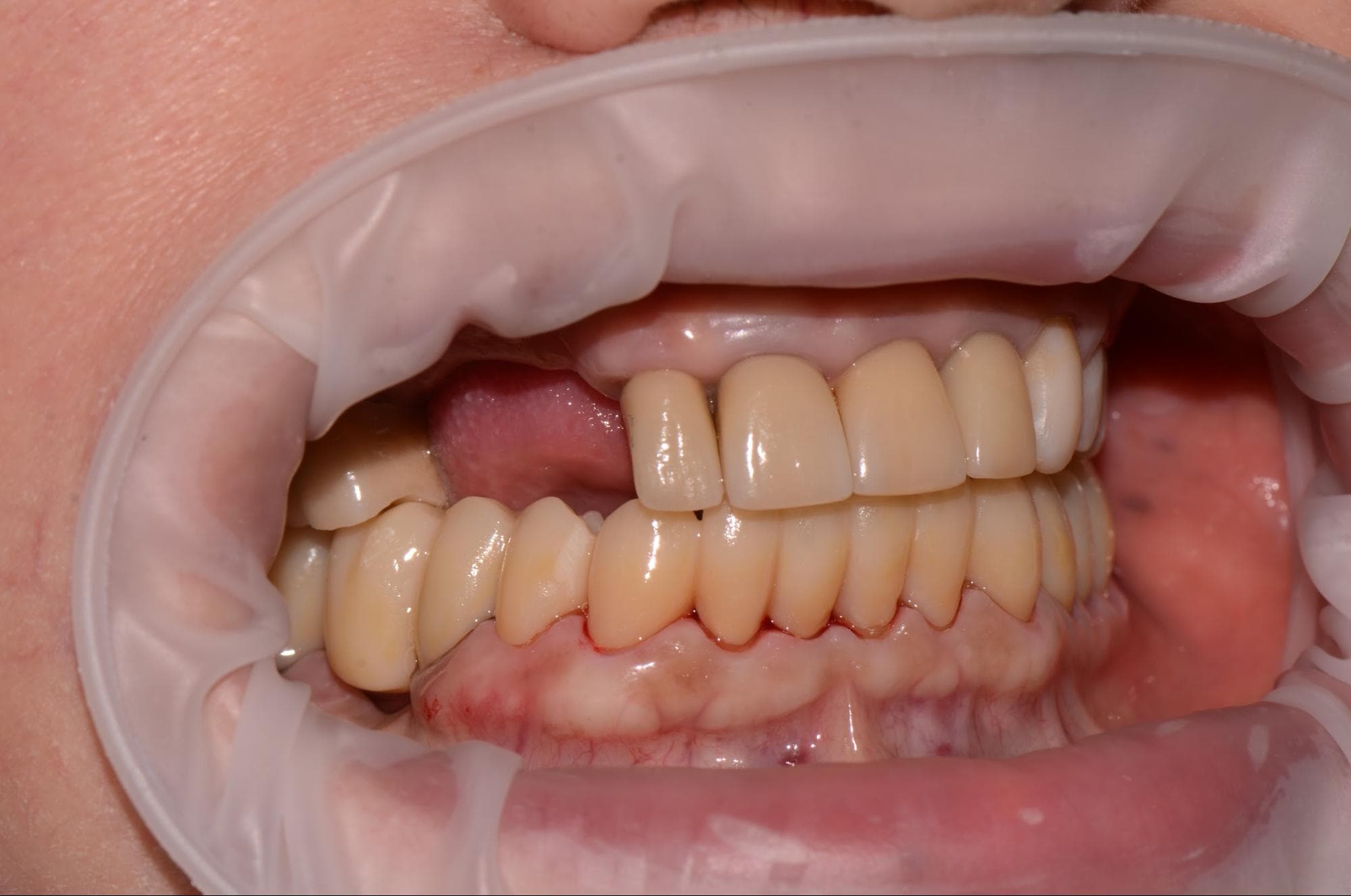 Increase of Vertical Dimension of Occlusion (VDO) with Temporary CB Resin in a Complex Rehabilitation Case