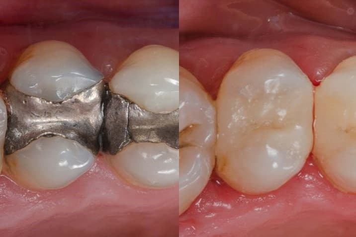 Maxillary Premolar Inlay Restorations with Permanent Crown Resin