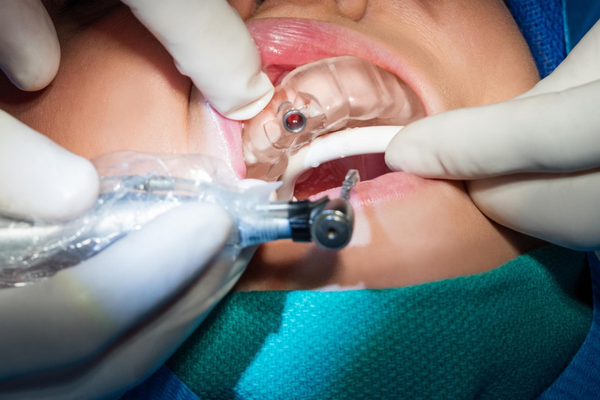 3D Printing Surgical Guides