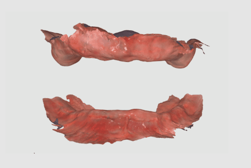 VDO of upper and lower jaw