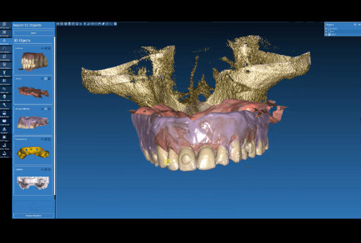 Aligning relined denture plus intraoral data to the anatomical landmarks in the CBCT.