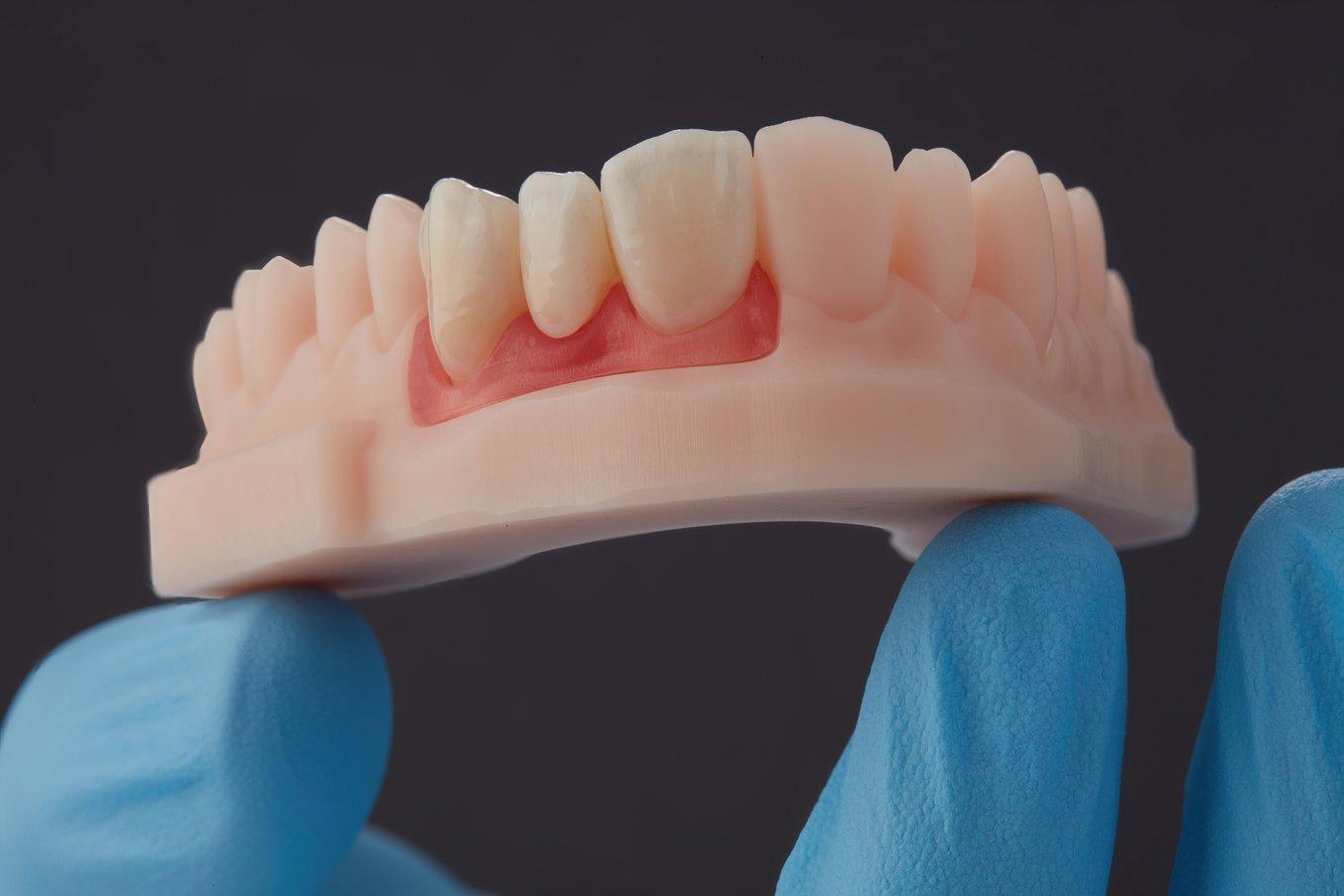 Acrylic teeth -Veneer Kit / Shade A2 False teeth / Temporary Tooth Repair  kit