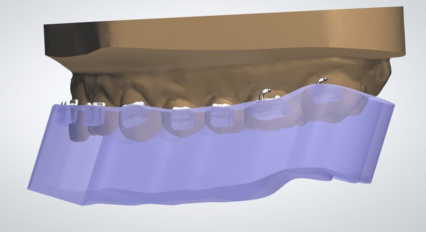 dental cad model