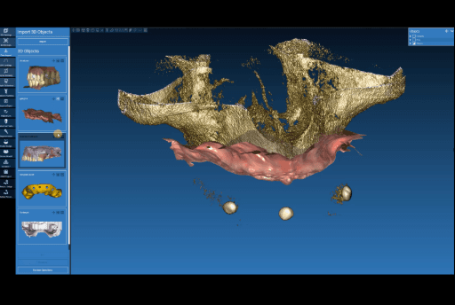 Intraoral data (soft tissue) aligned to the CBCT.