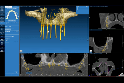Screenshot of surgical guide design in Real Guide
