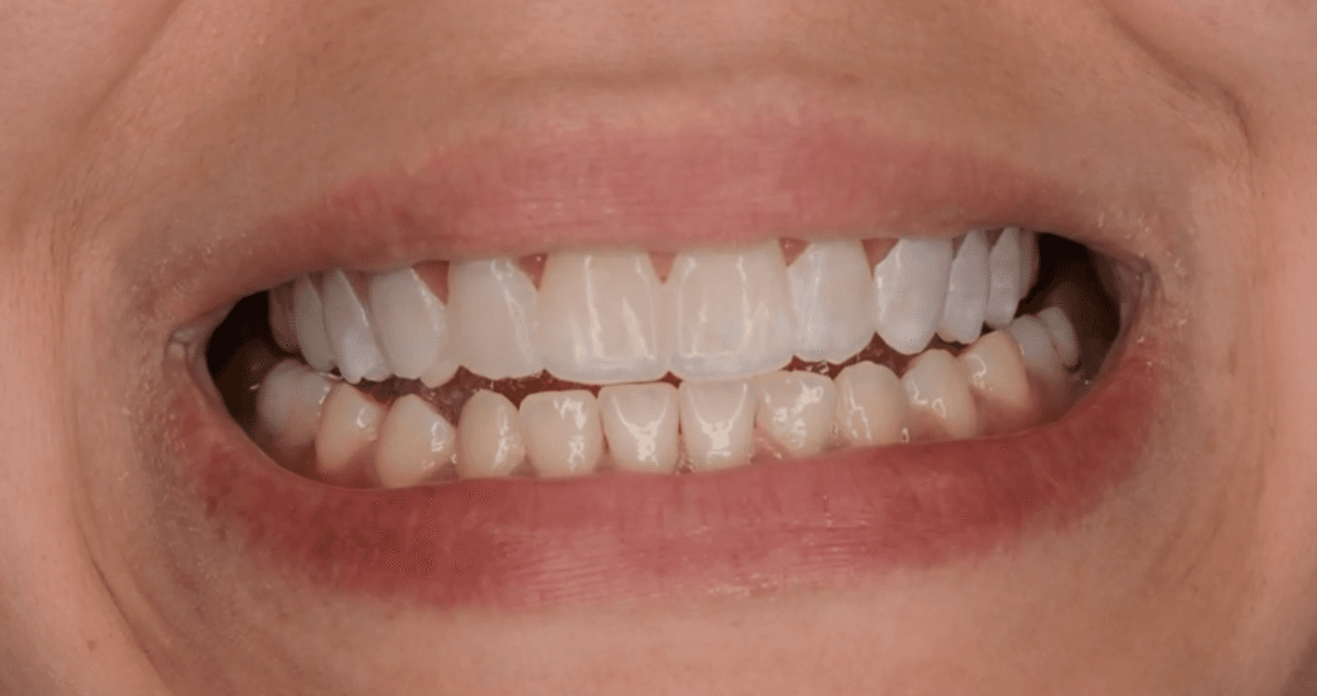 The shells in the mouth