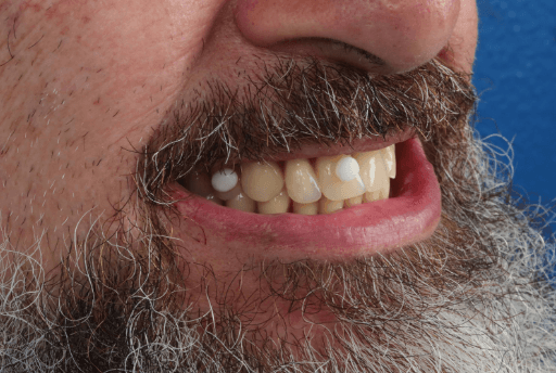 Dentures with anatomical landmarks