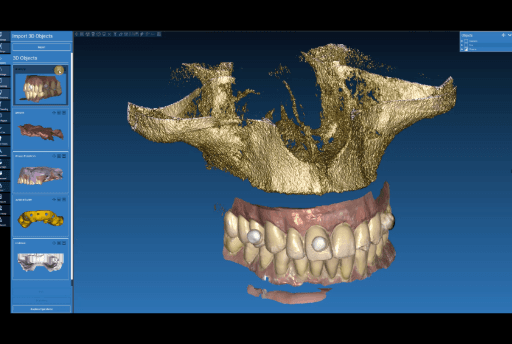 Screenshot of aligning CBCT with the dentures with anatomical landmarks.