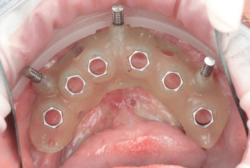 3D printed surgical guide with fixation pins