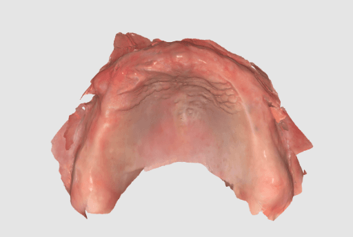 Intraoral scan of the upper jaw