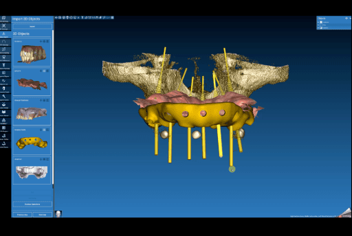 Screenshot of surgical guide design in Real Guide