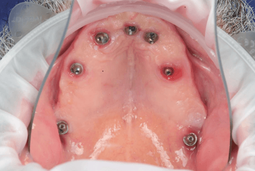 Intraoral view five months after procedure