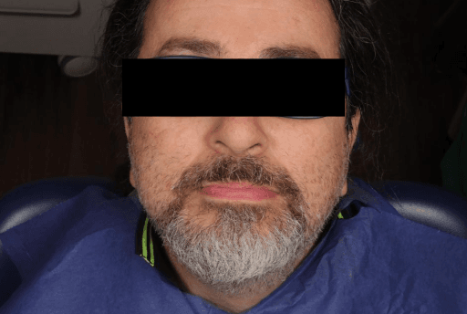 Photo of face with black bar over eyes