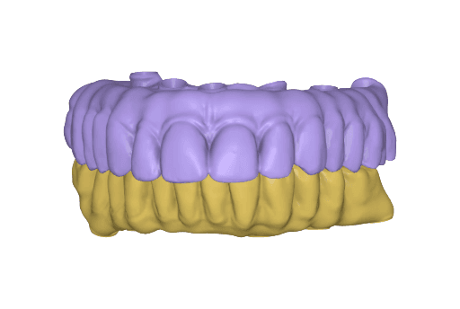 Temporary full-arch implant-supported appliances for the upper and lower arch designed in exocad upon the digital patient.