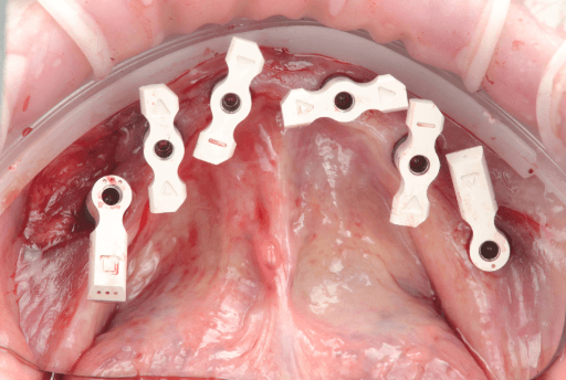 Photo of upper arch with Apollo scanbodies