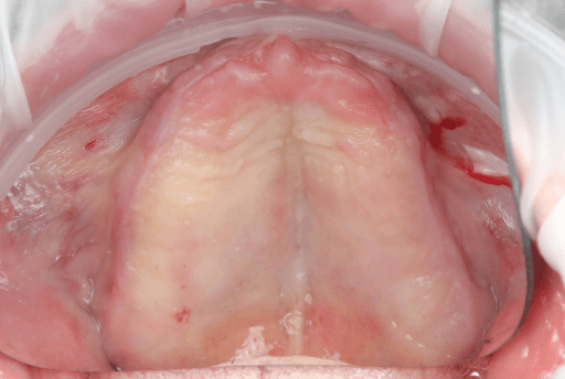Upper arch pre-surgical intraoral situation