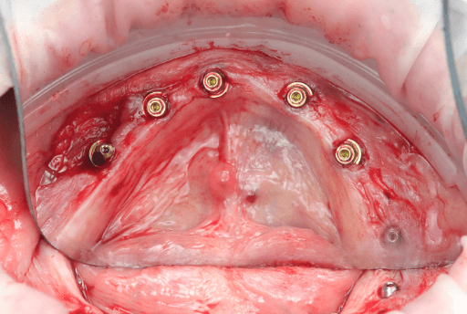 Lower arch with six implants placed