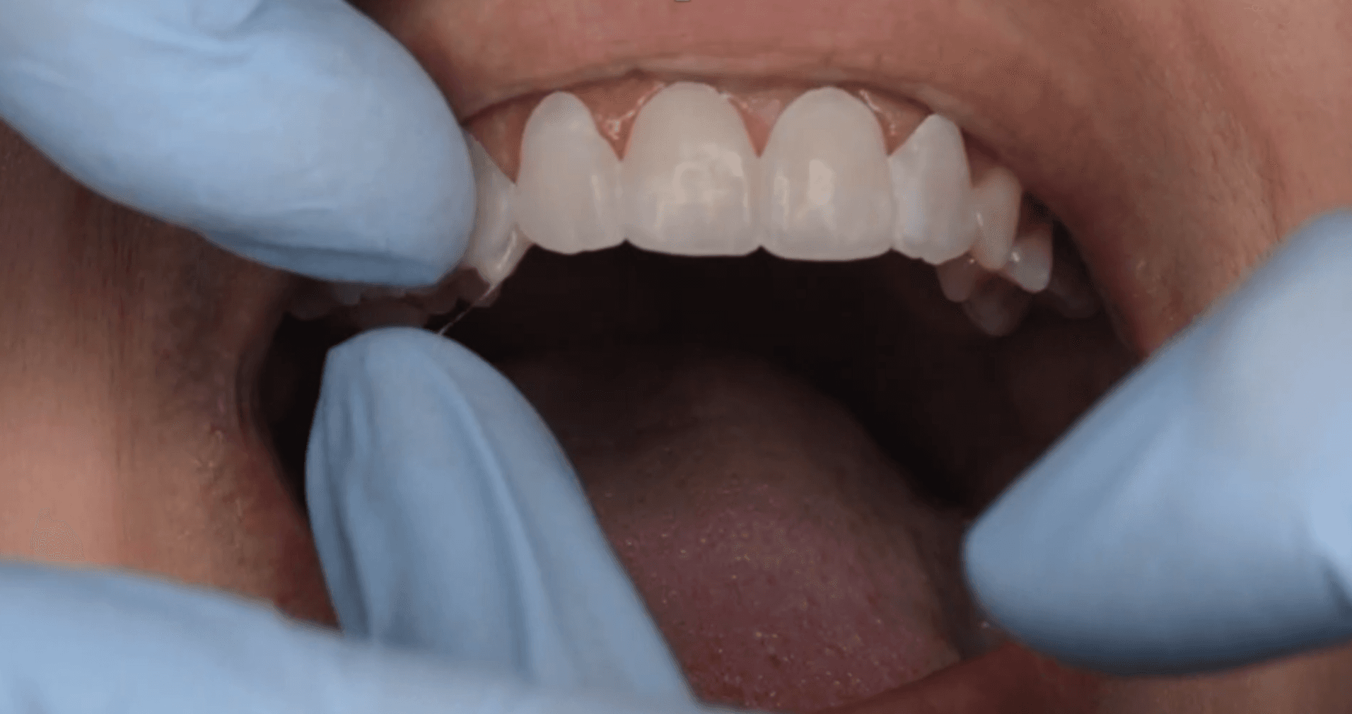 Placing a lateral shell
