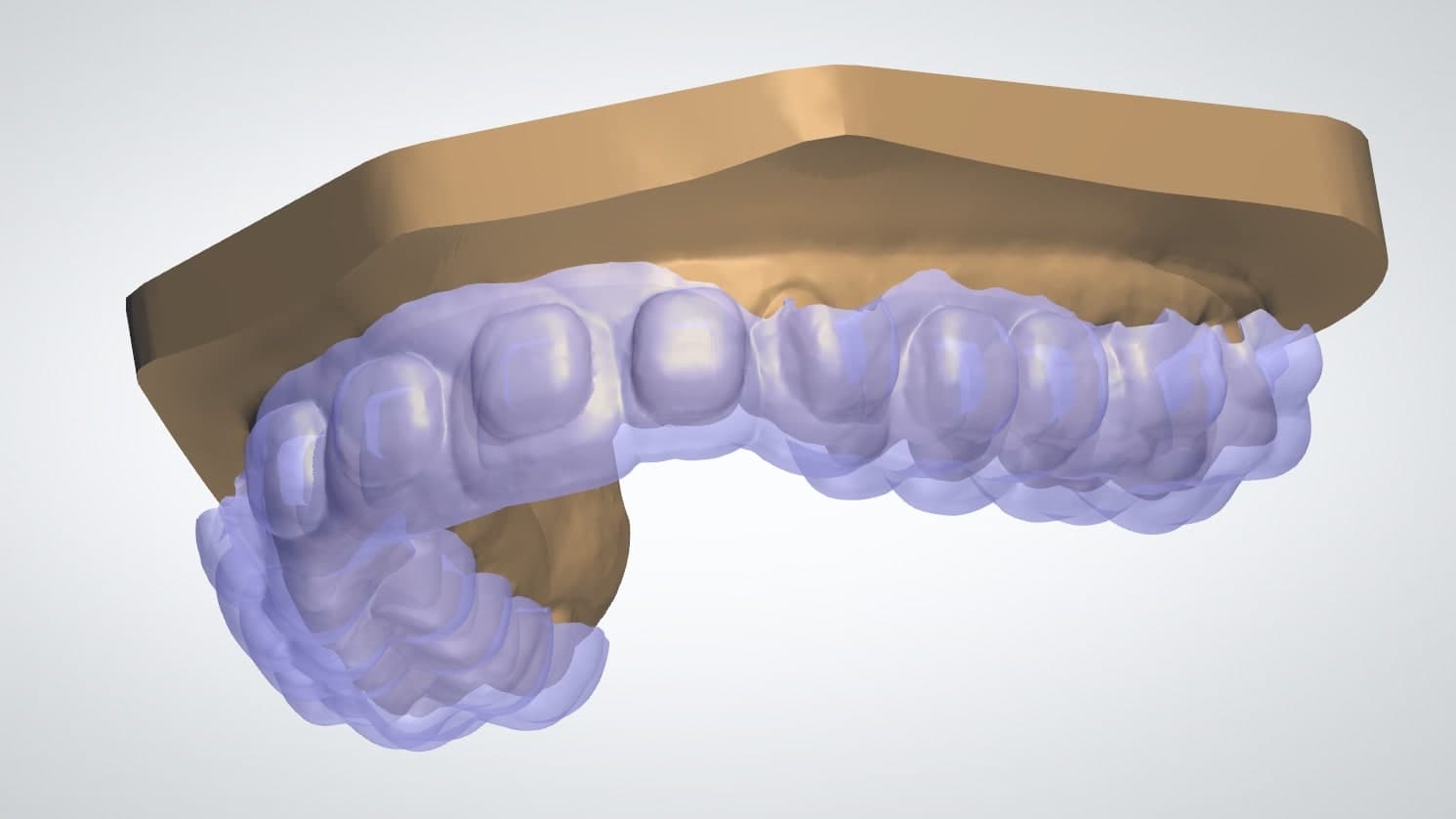 Offset type design example