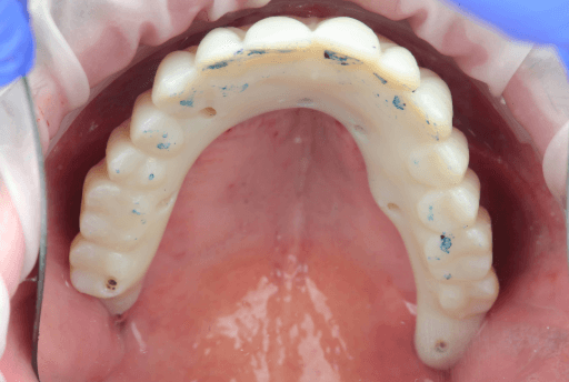 Occlusion check of upper All-on-X appliance