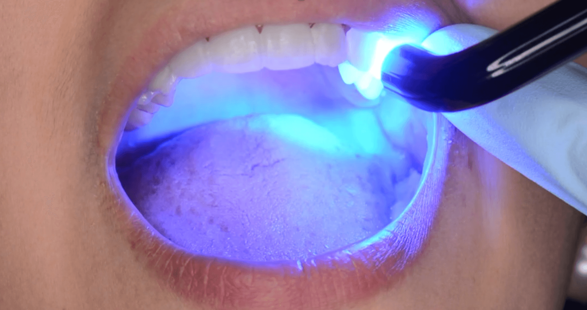 Light curing