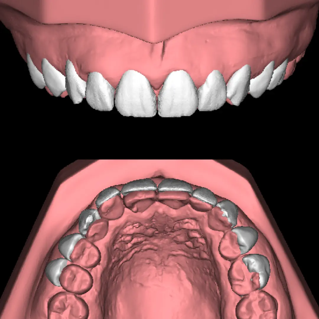 Image of mouth showing mock-up
