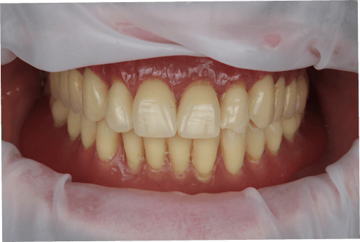 Dentures in the mouth