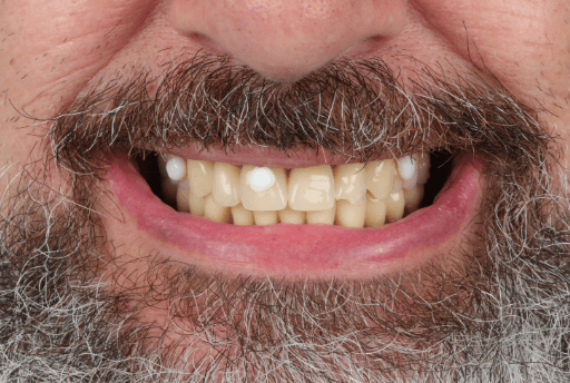 Dentures with anatomical landmarks