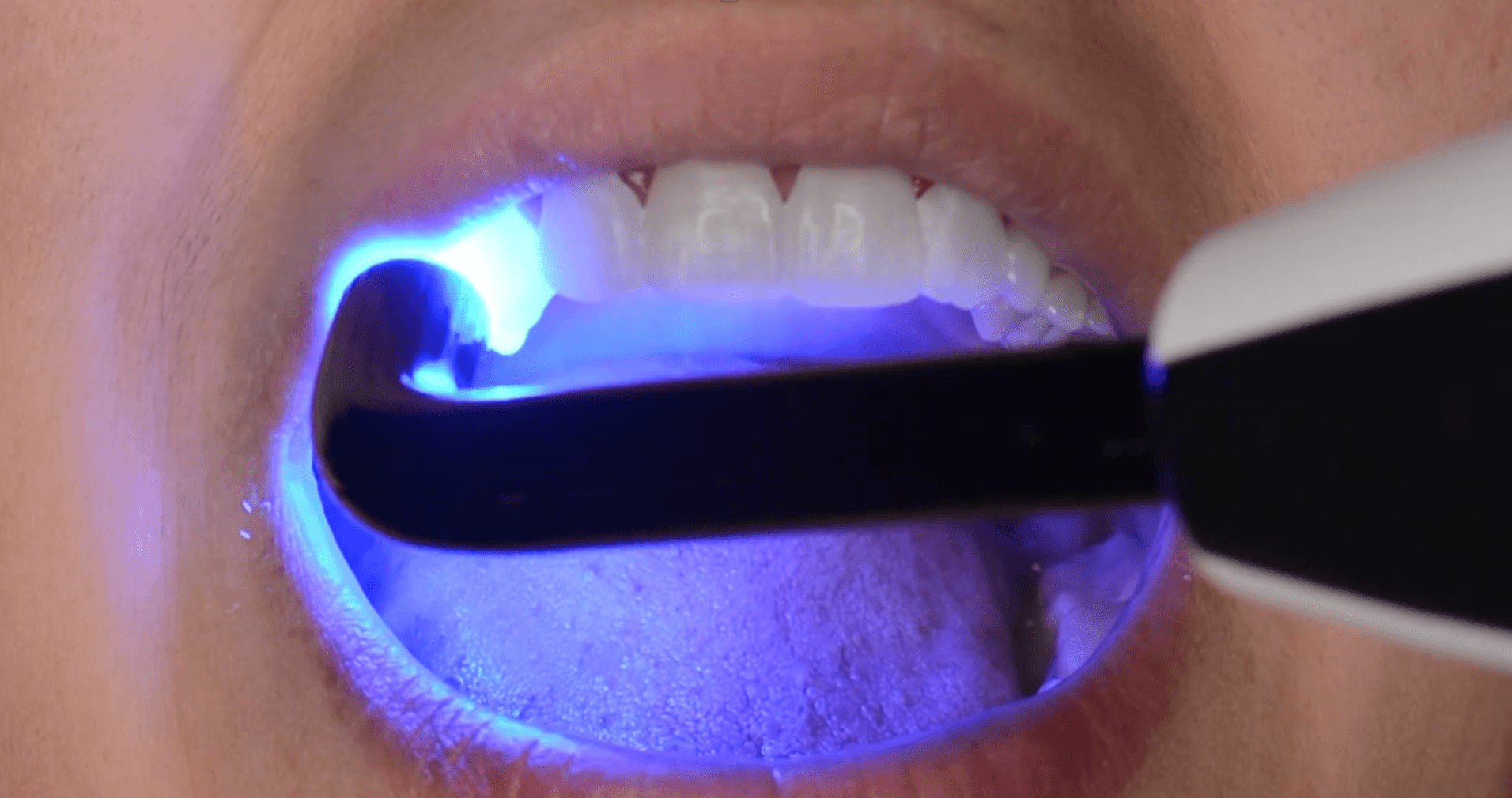 Light curing the shell