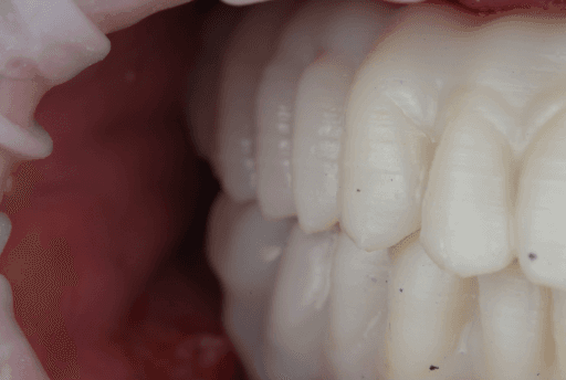 Occlusion check of All-on-X appliance