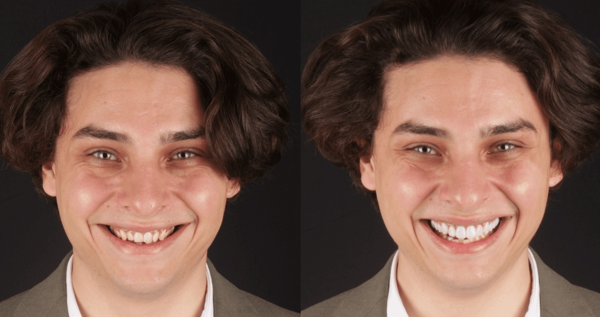 Person smiling showing before the mock-up and with the mock-up in place