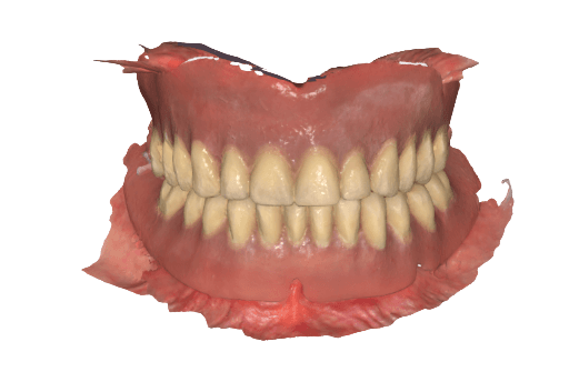 Scan of denture plus intraoral scan