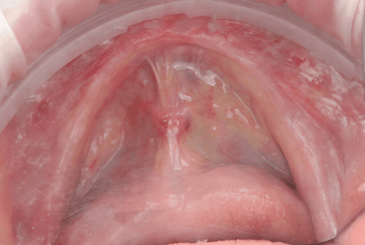 Lower arch pre-surgical intraoral situation