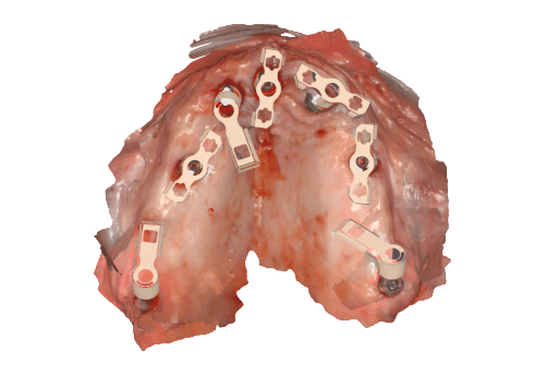 Intraoral scan of upper arch with Apollo scanbodies