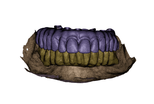 Temporary full-arch implant-supported appliances for the upper and lower arch designed in exocad