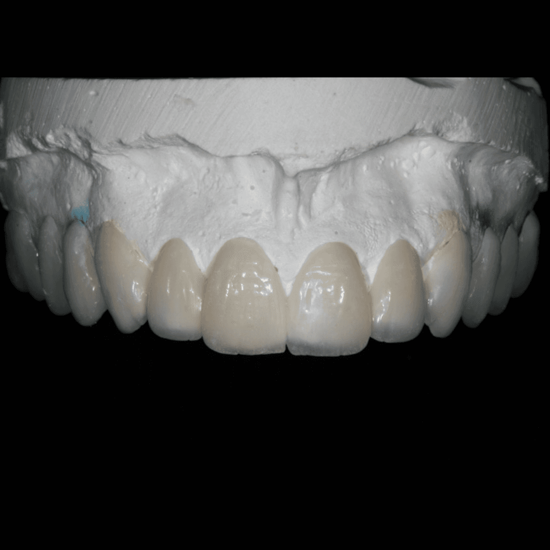 Mock-up teeth on a white dental model