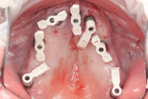 Upper arch with Apollo scan bodies