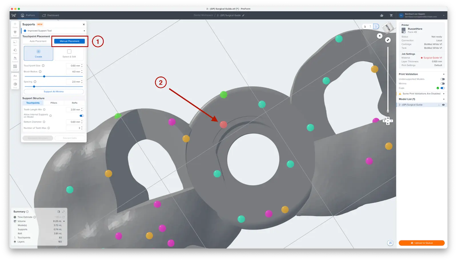manually placed support preform