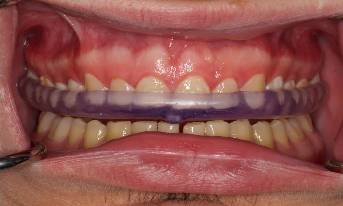 Occlusal splint delivered to the patient.