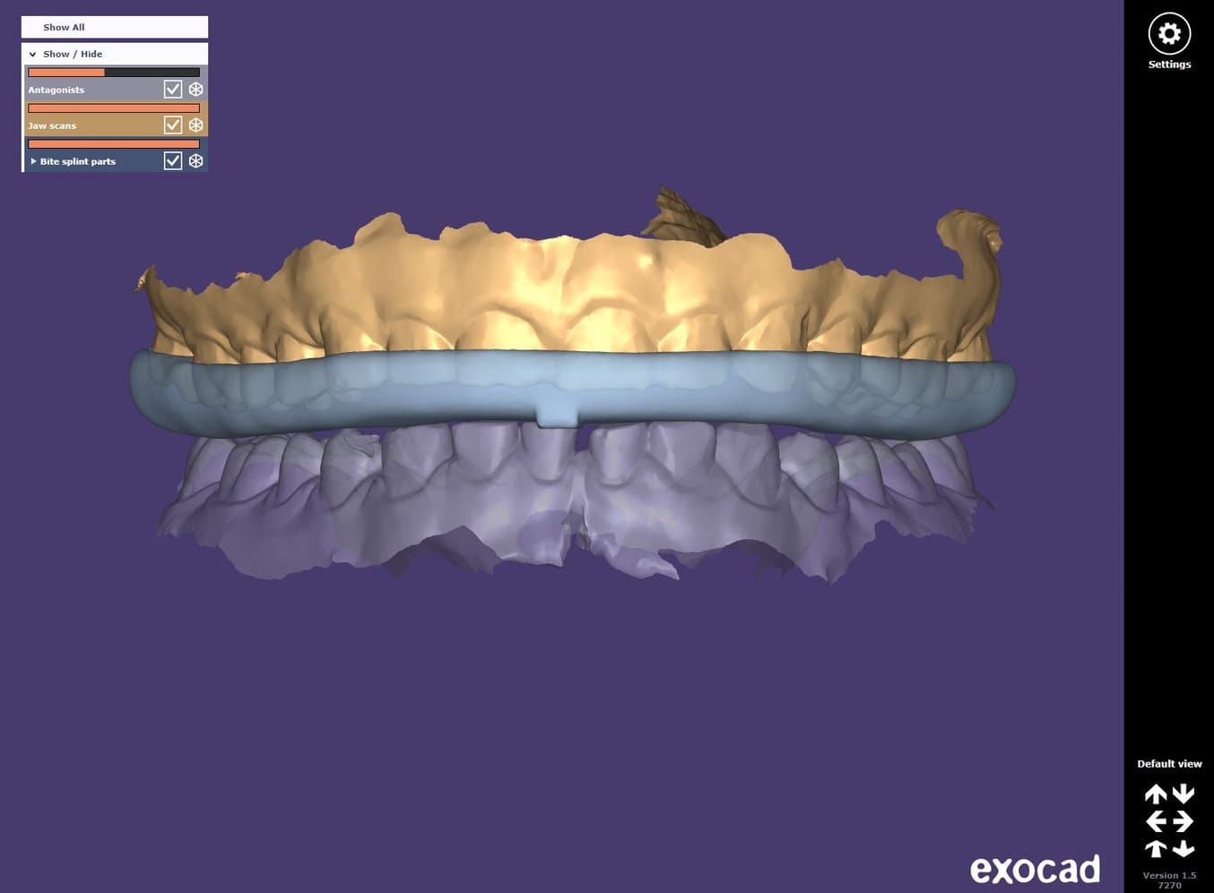 gouttière occlusale conçue dans exocad