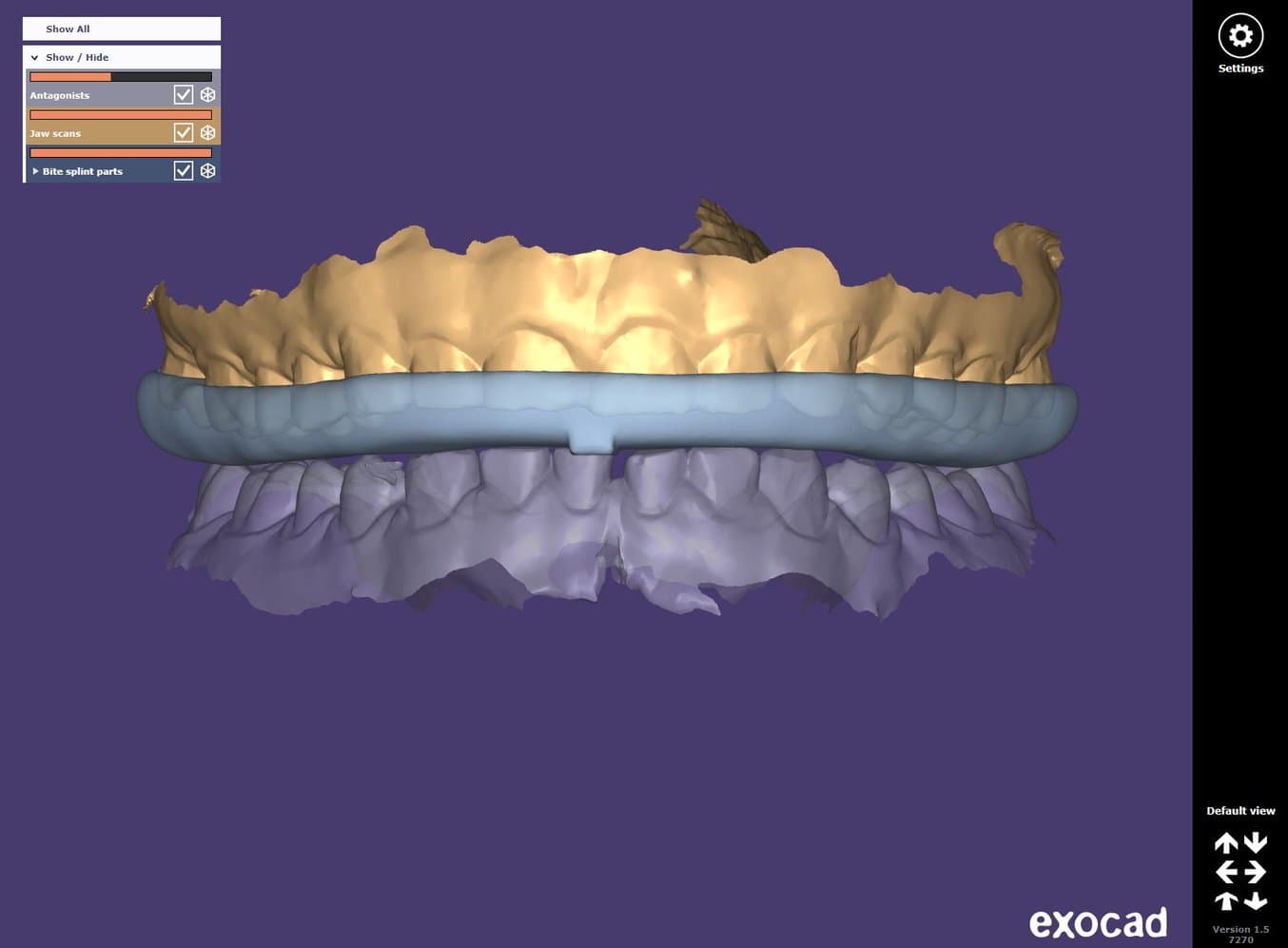 occlusal splint designed in exocad