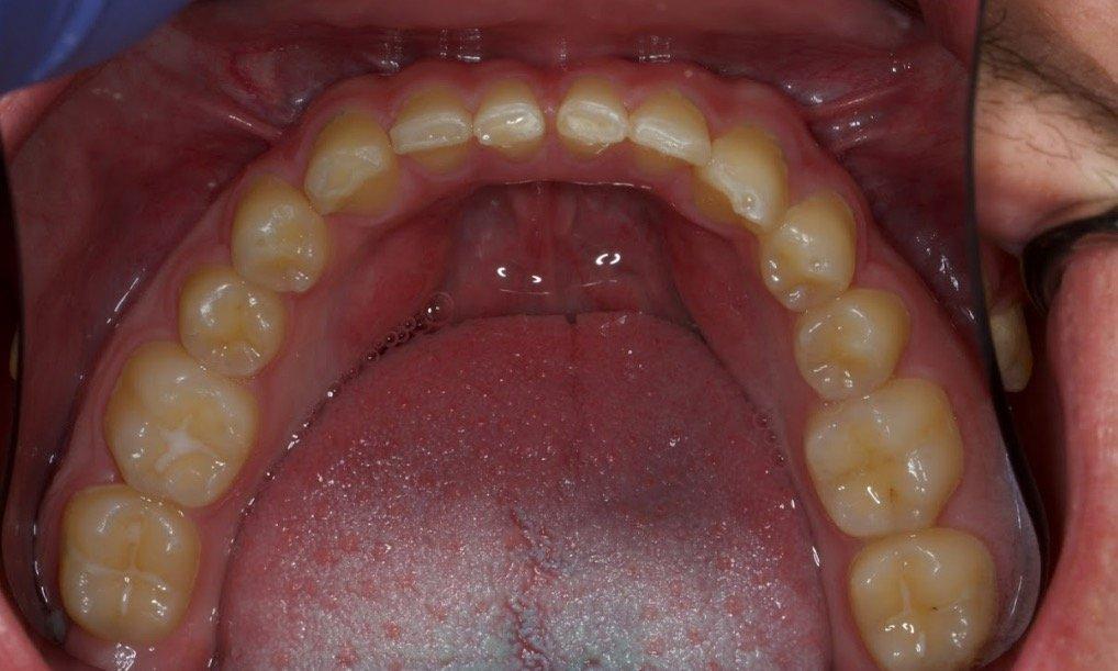 Intraoral picture of the lower arch