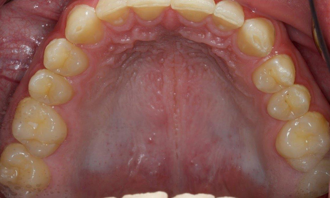 Intraoral picture of the upper arch