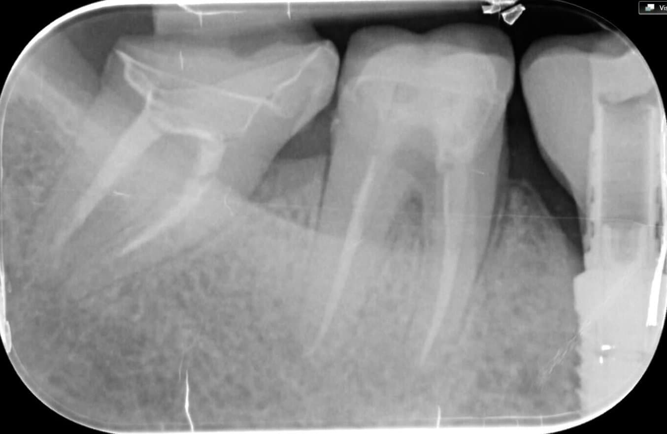 X-ray of BEGO™ VarseoSmileⓇ TriniQⓇ Resin