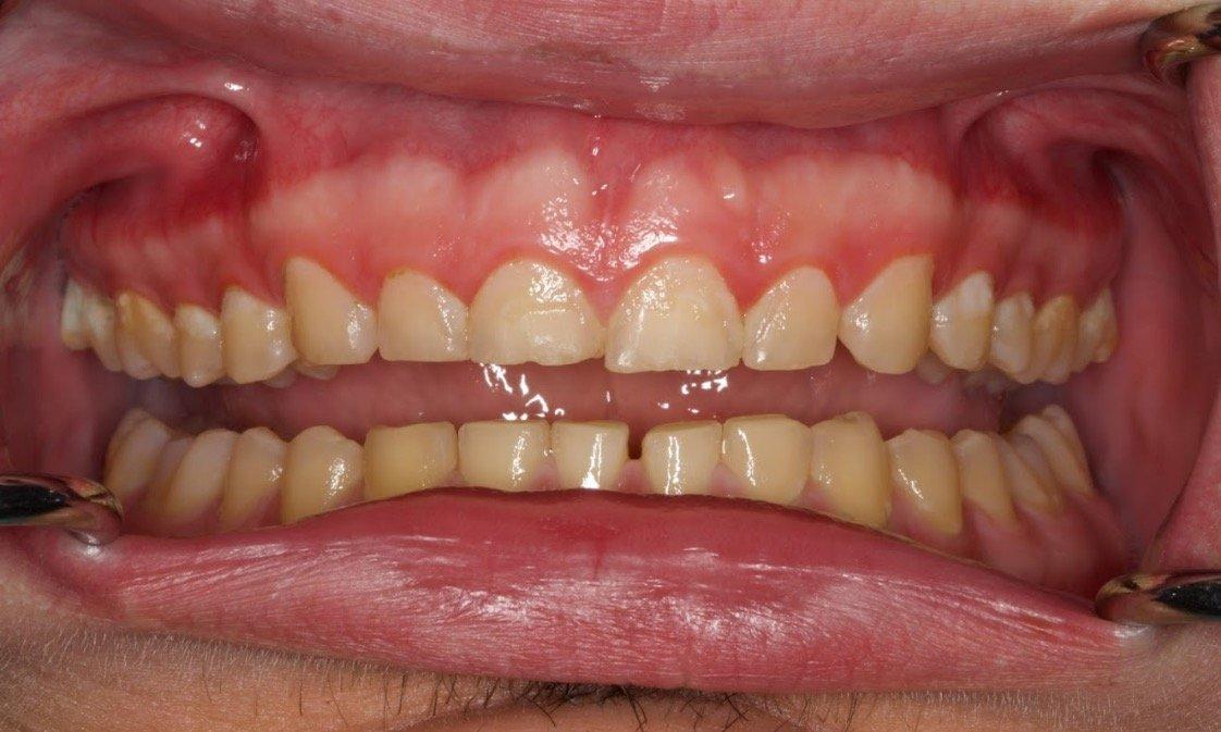 Intraoral picture showcasing the extensive wear