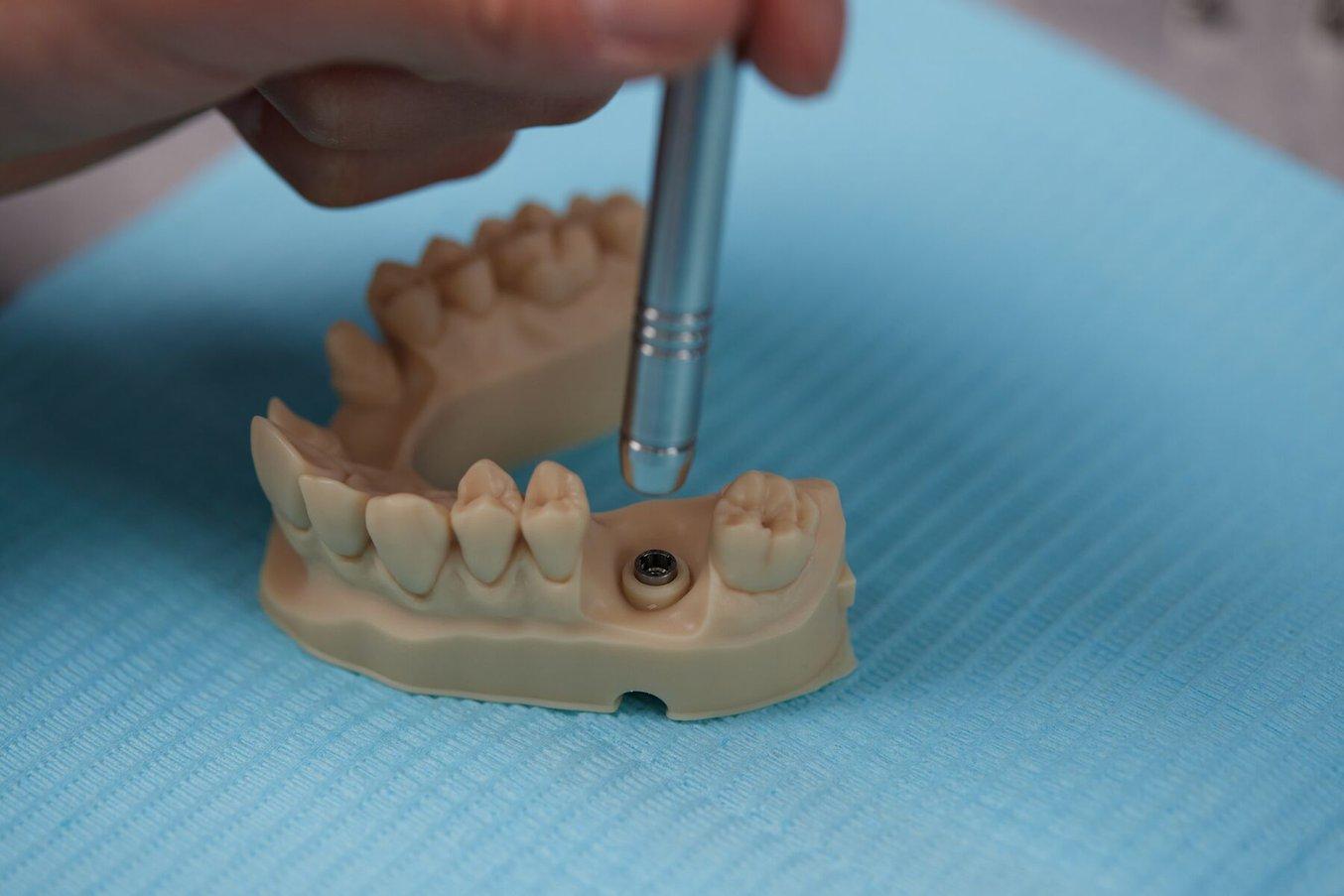 Parti dentali stampate in 3D con la Precision Model Resin
