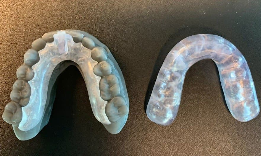 Kois Deprogrammer and occlusal splint after polishing.