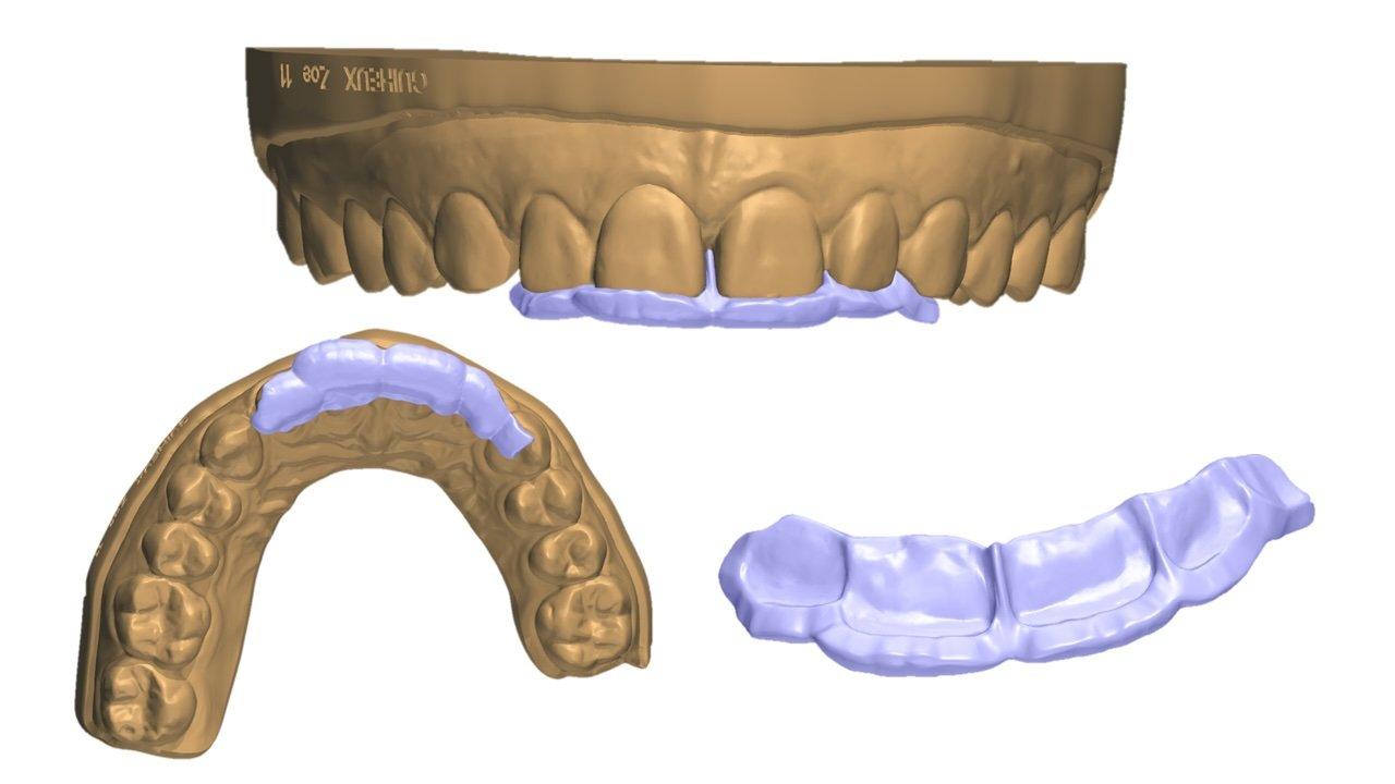 A CAD model of an intraoral scan with a design of a direct composite guide