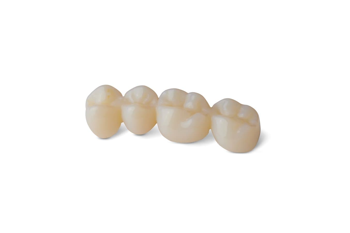 A temporary bridge of four units printed in Premium Teeth Resin