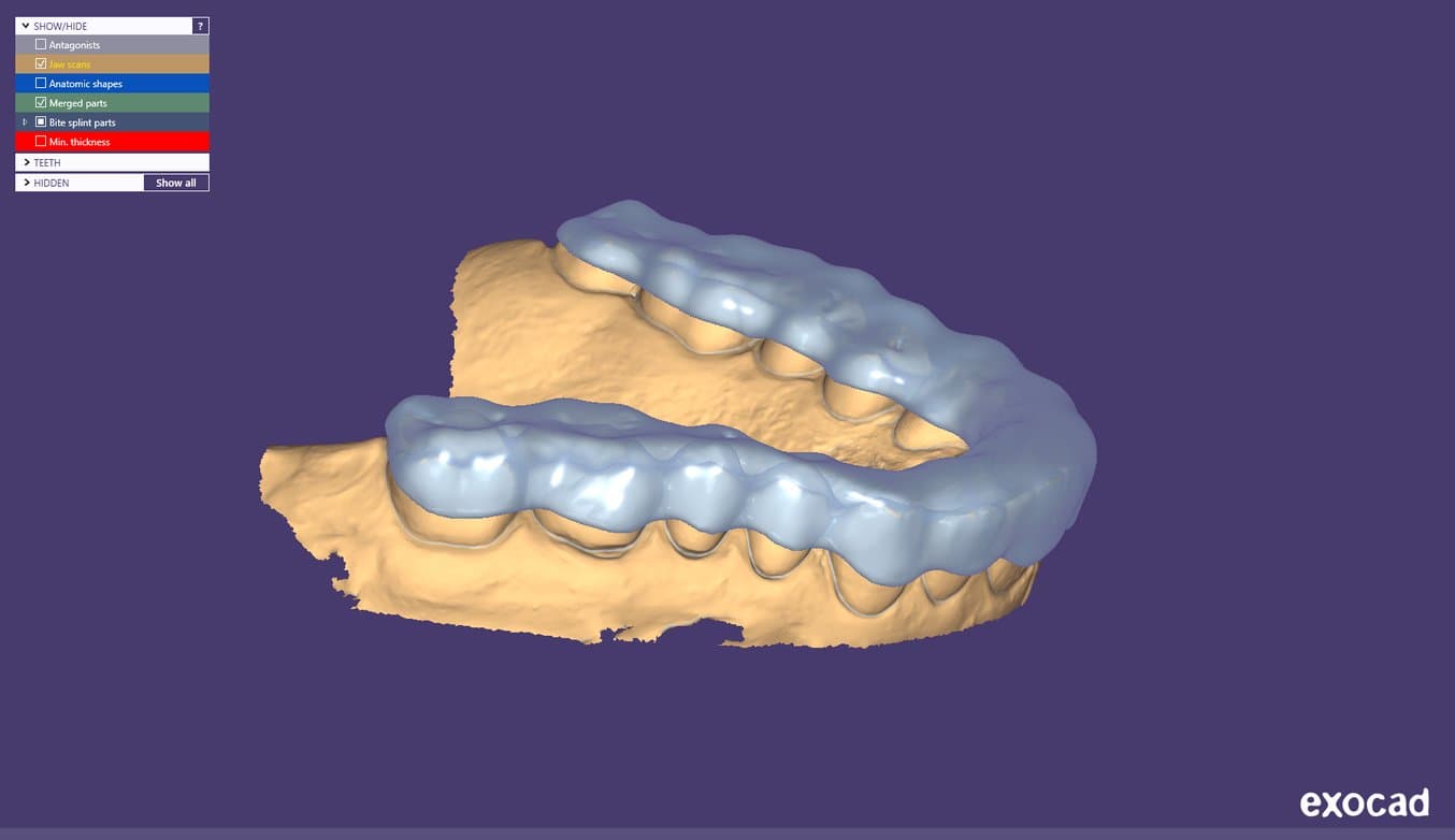 An occlusal splint being designed in exocad.